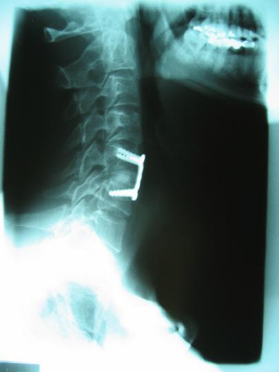 Cervical Fusion, C5/C6; side view